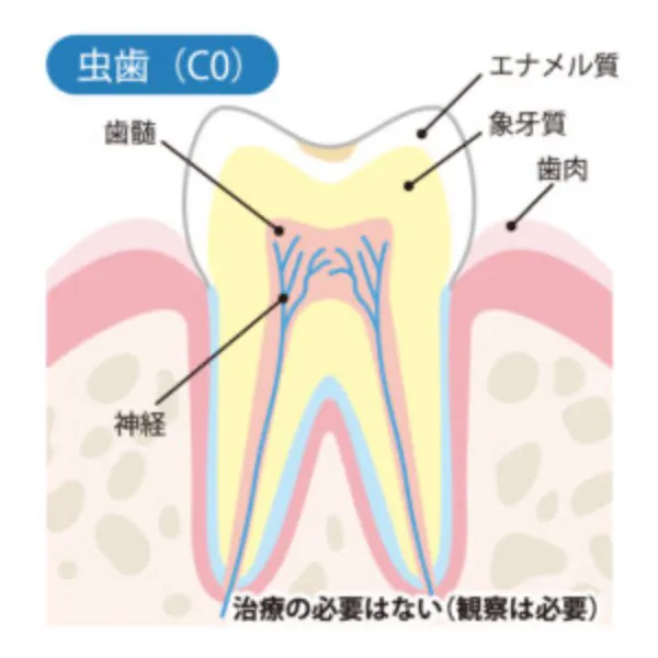 （C0）痛みがない虫歯