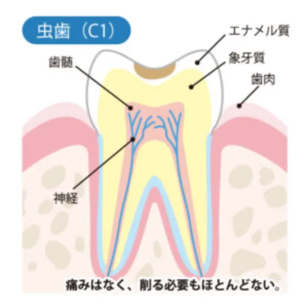 （C1）黒っぽく見える虫歯