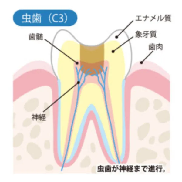 （C3）ズキズキ強く痛む虫歯