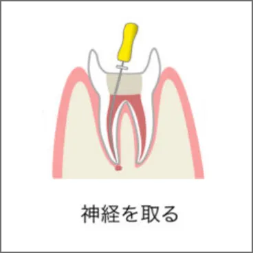 レントゲンやCTを撮り、虫歯部分を削る