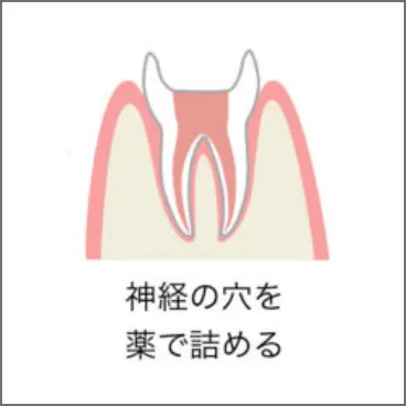 レントゲンやCTを撮り、虫歯部分を削る