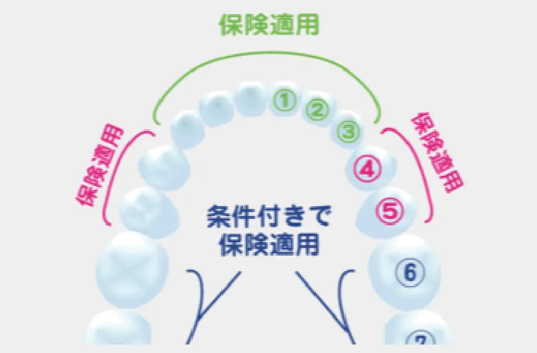 ハイブリッドセラミックは保険が適用される