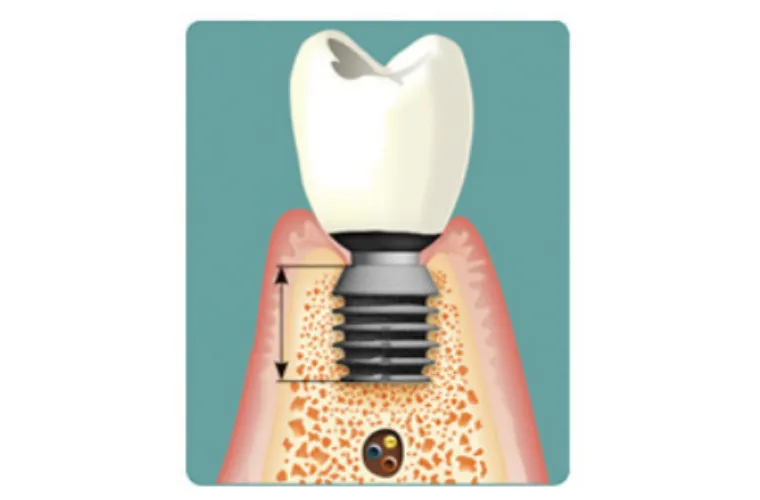 インプラントの仕組み