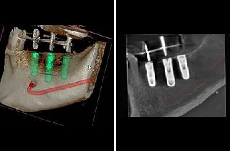 正確な手術のためのシミュレーション