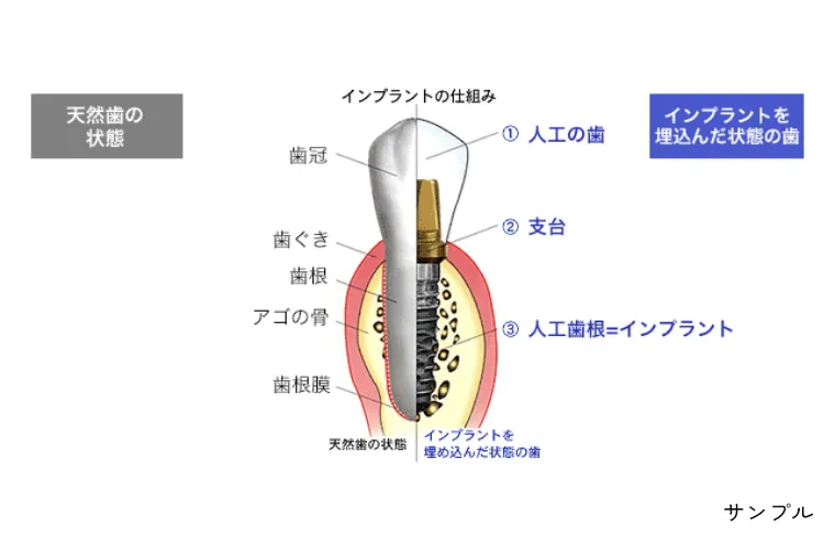 なぜ顎の骨に埋め込むのですか？