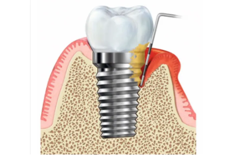 インプラント周囲炎とは？