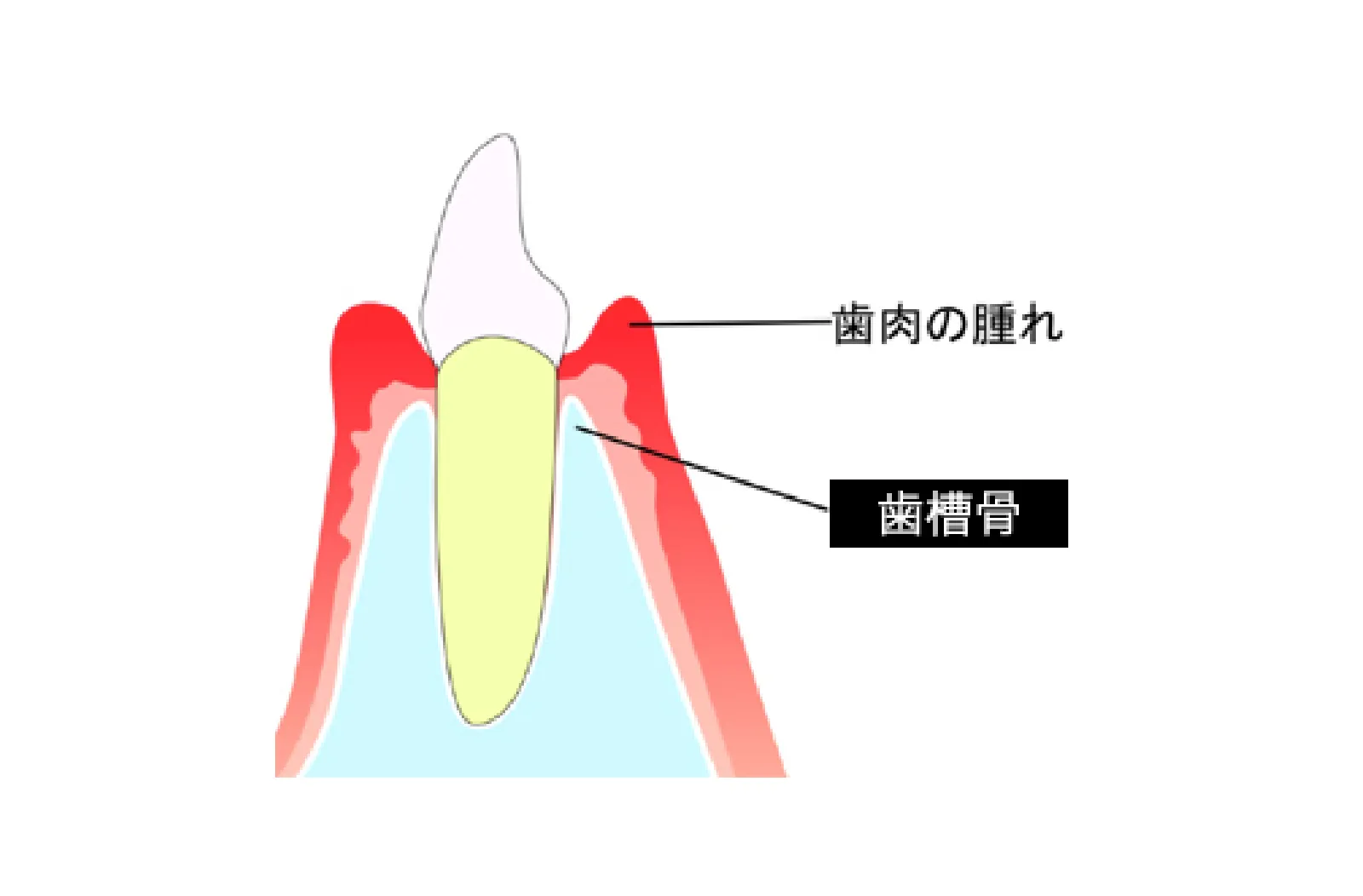 骨が溶けてしまう歯周病