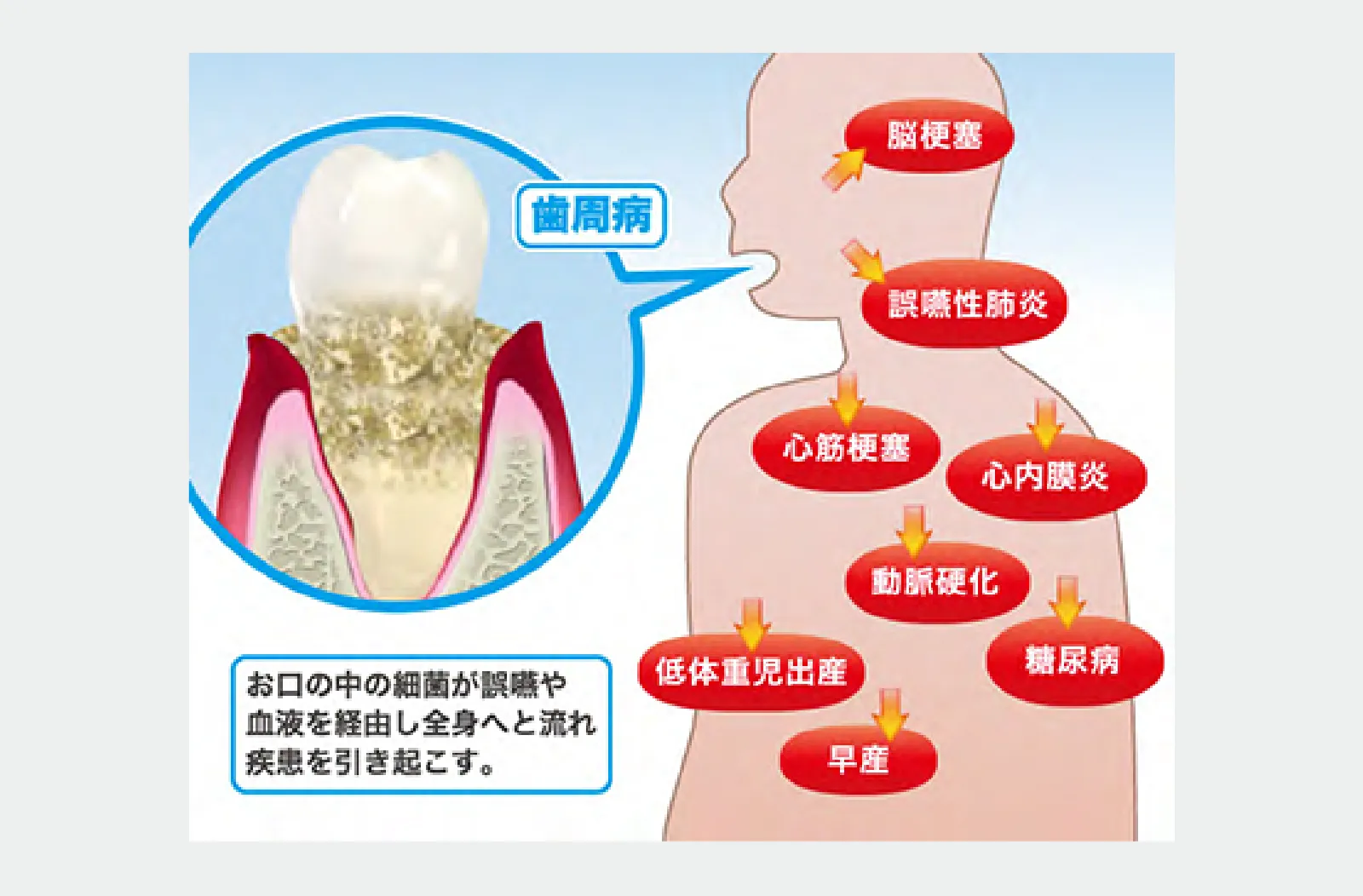 全身へ影響する歯周病