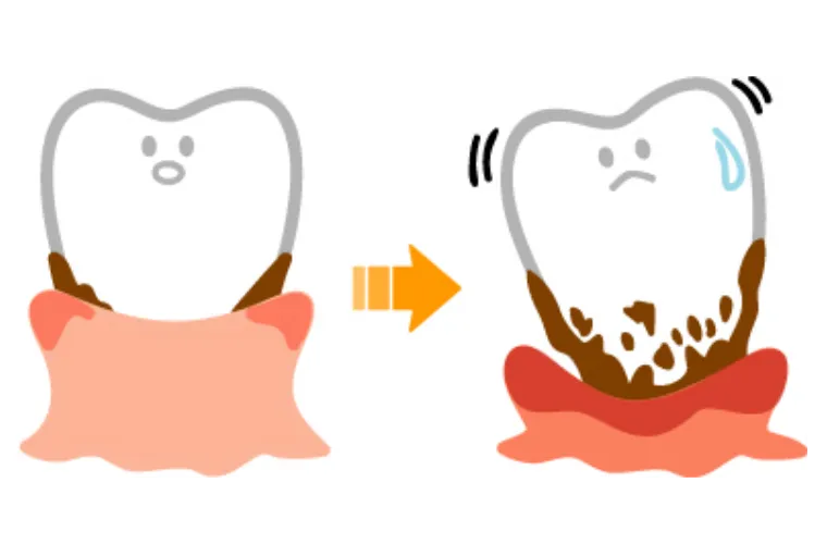 プラークが固まって歯石になる
