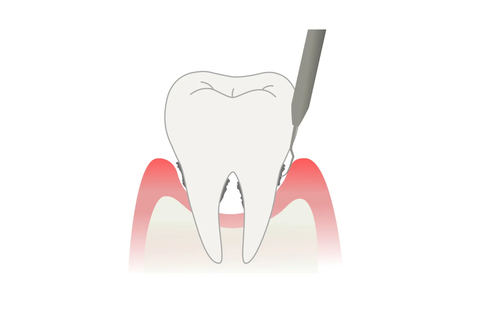 歯周病の治療方法