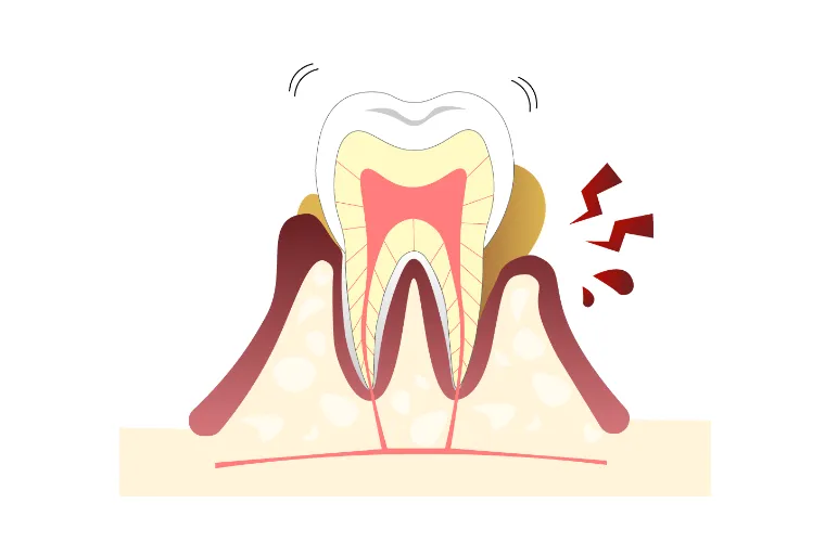 歯周病とは
