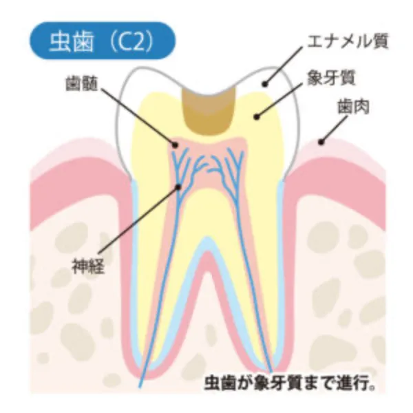 （C2）痛みがある虫歯