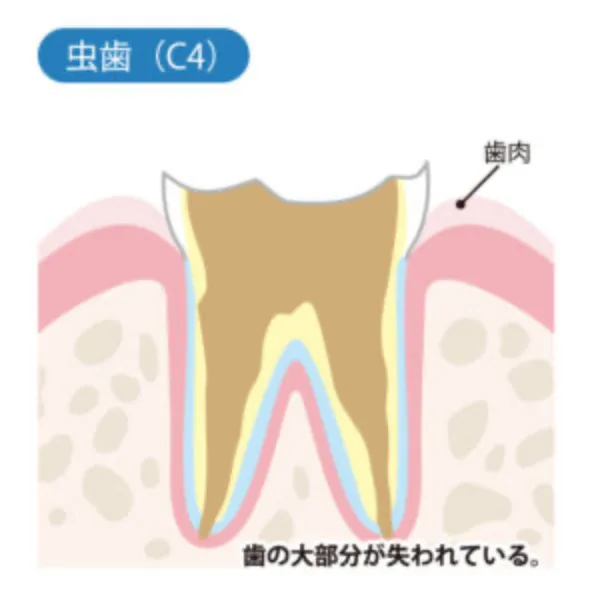 （C4）歯の大部分が失われた虫歯