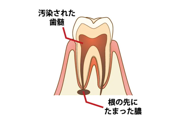 歯の根っこを治療する根管治療