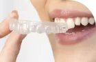 歯列矯正のカテゴリ