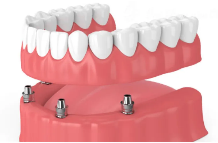 総入れ歯には多くのインプラントが必要ですか？