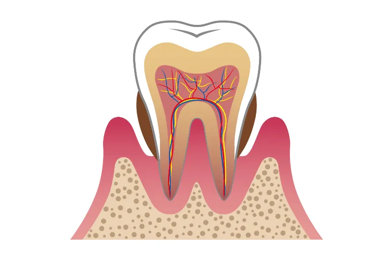 歯の根元にできる虫歯とは