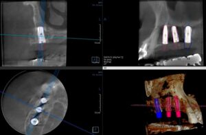 インプラントオペ