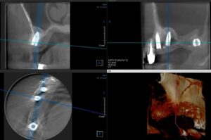 今年のインプラントオペ二回目