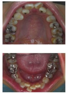 金属アレルギー　全快