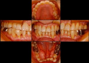 前回の続きのインプラント矯正
