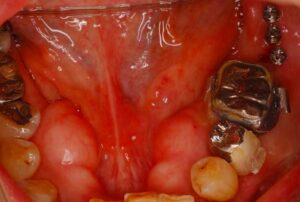 インプラント矯正が旬です。