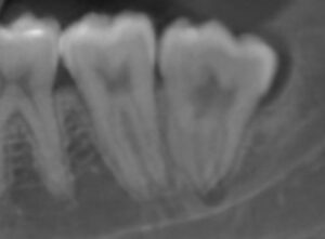 バイコンインプラント研修5