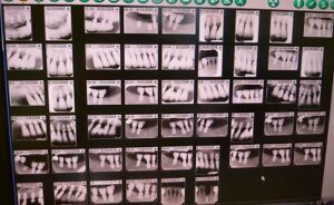 バイコンインプラント研修6