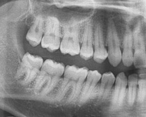 無料メール相談3(親知らずは抜歯した方が良いですか？)