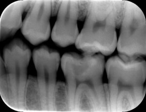 歯に詰めるプラスチックが危ない 　パート2