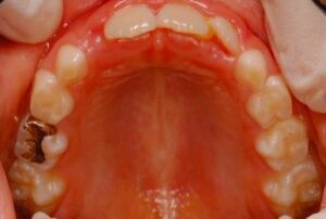 無料メール相談2 (矯正は何歳から始めたら良いですか？)