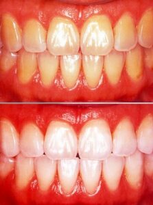 無料メール相談6(歯のホワイトニングしたいのですが、詰め物も白くなりますか？)