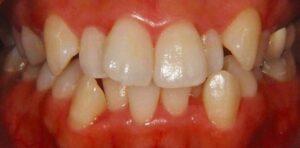 無料メール相談4(抜歯しない矯正方法って無いのですか？)