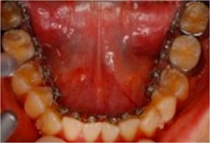 無料メール相談5(見えない矯正方法ってどんなのがありますか？)