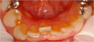 無料メール相談 (1本だけの矯正は可能ですか？)