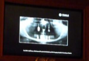 ボストンでバイコンインプラント研修4