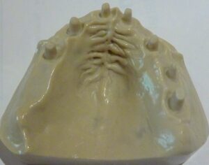 ボストンでバイコンインプラント研修3