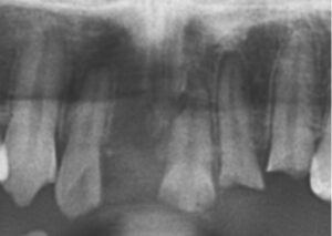 歯の外傷時の応急処置