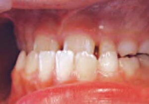 歯科正治療の開始時期　パート3  (反対咬合)