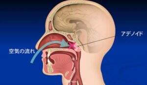 歯並びに影響する悪習慣2　口呼吸