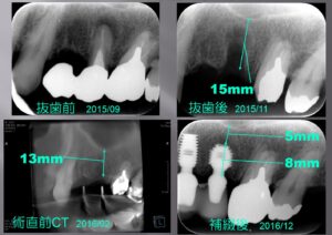 上顎洞底挙上術2
